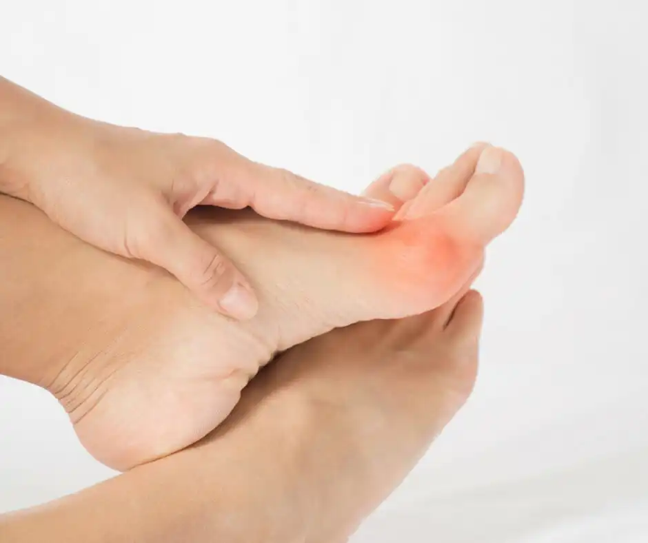 Big Toe Joint: Bunion <em>(Hallux Abducto Valgus)</em> 8 Big Toe Joint: Bunion - Foot with a red, swollen bunion at the big toe joint, showing toe misalignment.