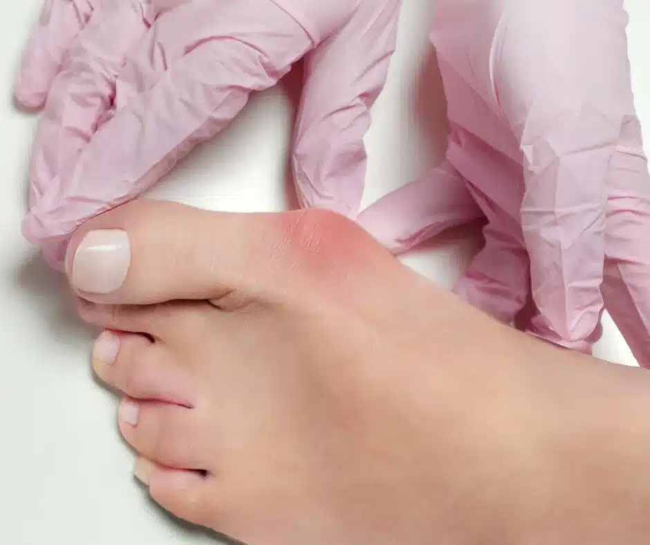 Big Toe Joint: Bunion Repair: Lapiplasty Big Toe Joint: Bunion Repair: Lapiplasty - Foot displaying a bunion deformity at the big toe joint