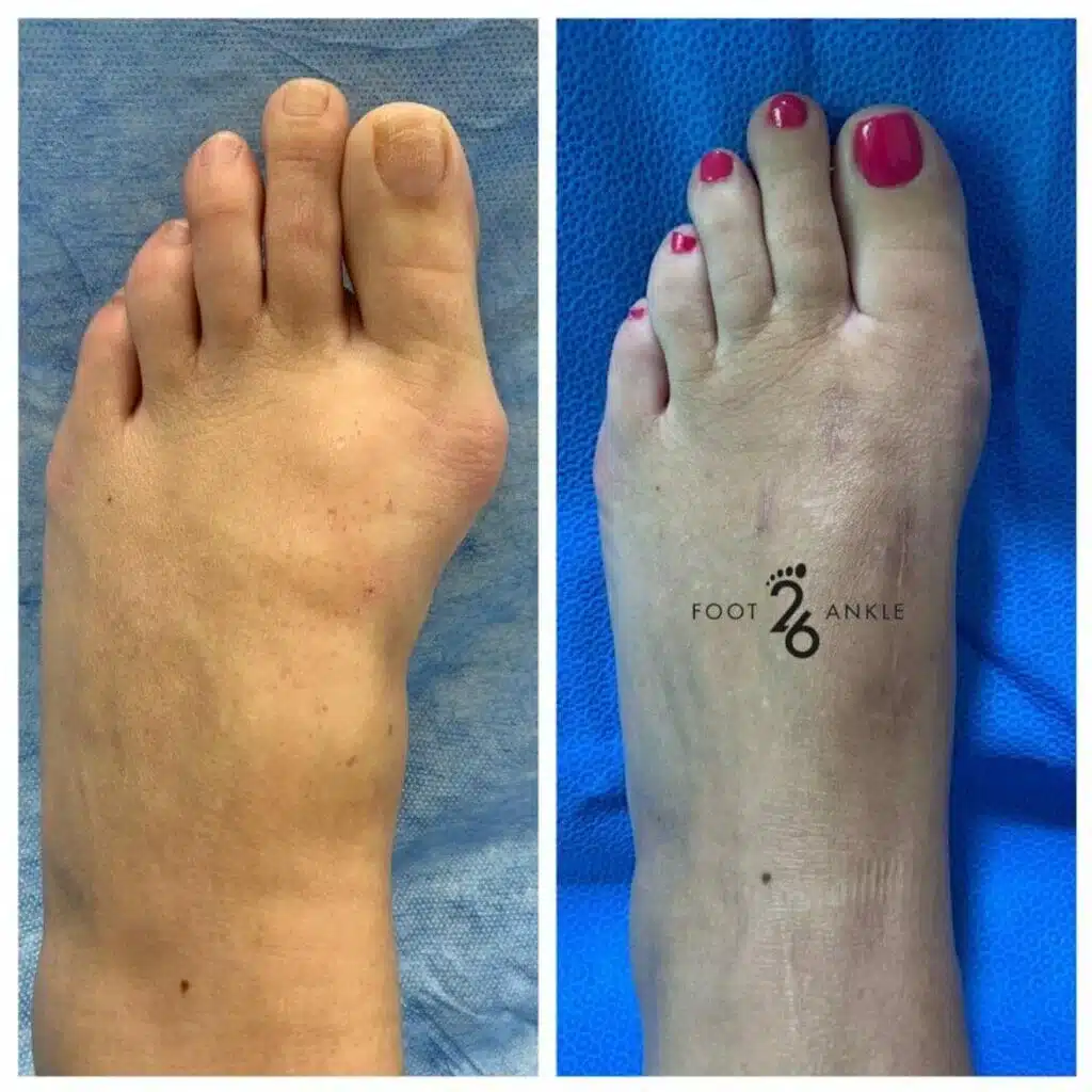 Big Toe Joint: Bunion Repair: Lapiplasty Big Toe Joint: Bunion Repair: Lapiplasty - Diagram showing the Lapiplasty procedure correcting bunion deformity