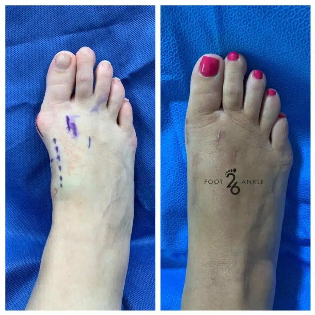 Big Toe Joint: Bunion Repair: Lapiplasty Big Toe Joint: Bunion Repair: Lapiplasty - Illustration of recovery stages following Lapiplasty bunion surgery