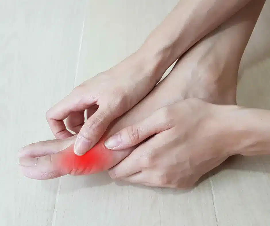 Big Toe Joint: Bunion Repair: Standard - Foot displaying a bunion deformity prior to surgical correction