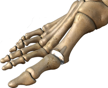 26 Foot and Ankle Big Toe Joint Replacement