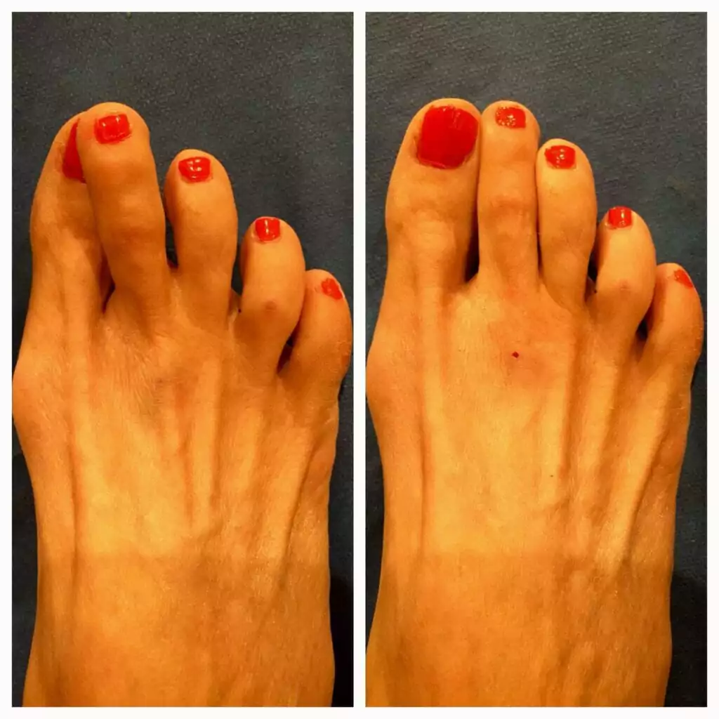 Hammertoe: Severe Crossover Toe 3 Hammertoe: Severe Crossover Toe - Foot with severe crossover toe deformity, where the second toe overlaps the big toe, illustrating a hammertoe variant affecting the MPJ and proximal interphalangeal joint.