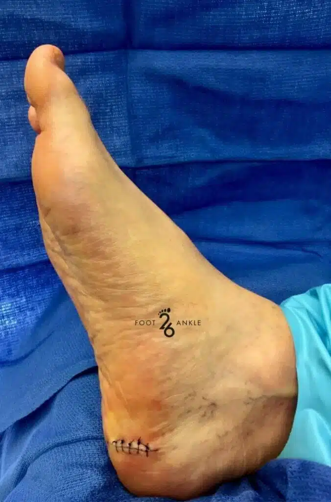 Heel Pain Surgery: Plantar Fasciitis 4 Illustration of plantar fasciitis surgery showing partial release of the plantar fascia ligament to alleviate chronic heel pain.