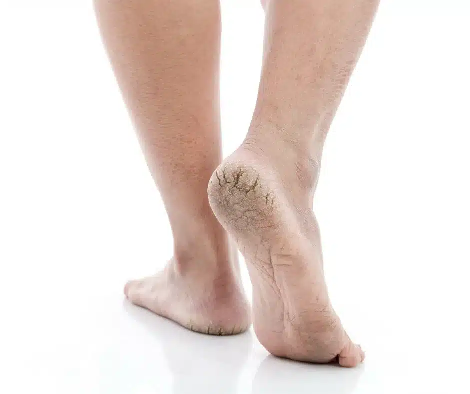 Skin: Dry Cracked Skin - Close-up of dry, cracked skin on heels receiving professional podiatry care for healthier feet.