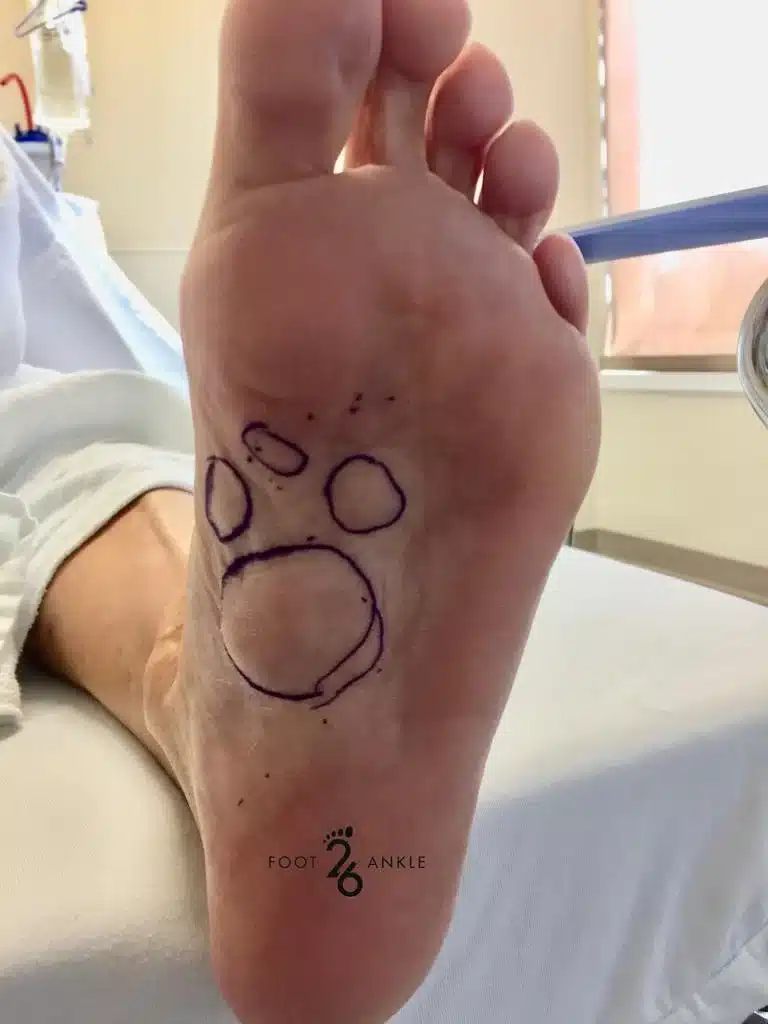 Plantar Fibroma - Soft Tissue Mobilization therapy targeting a plantar fibroma.