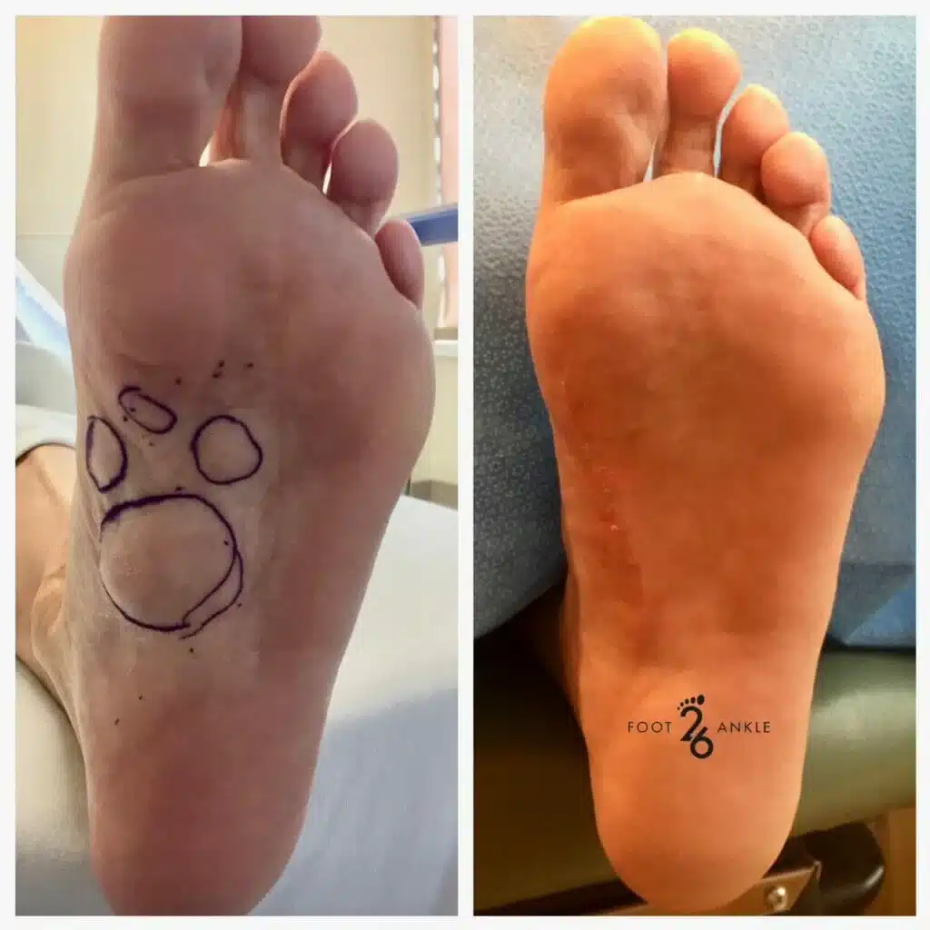 Plantar Fibroma - Plantar fibroma size reduction after targeted treatment.