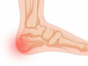 Calcaneal Apophysitis-Sever's Disease Heel Pain Treatment At Home Options