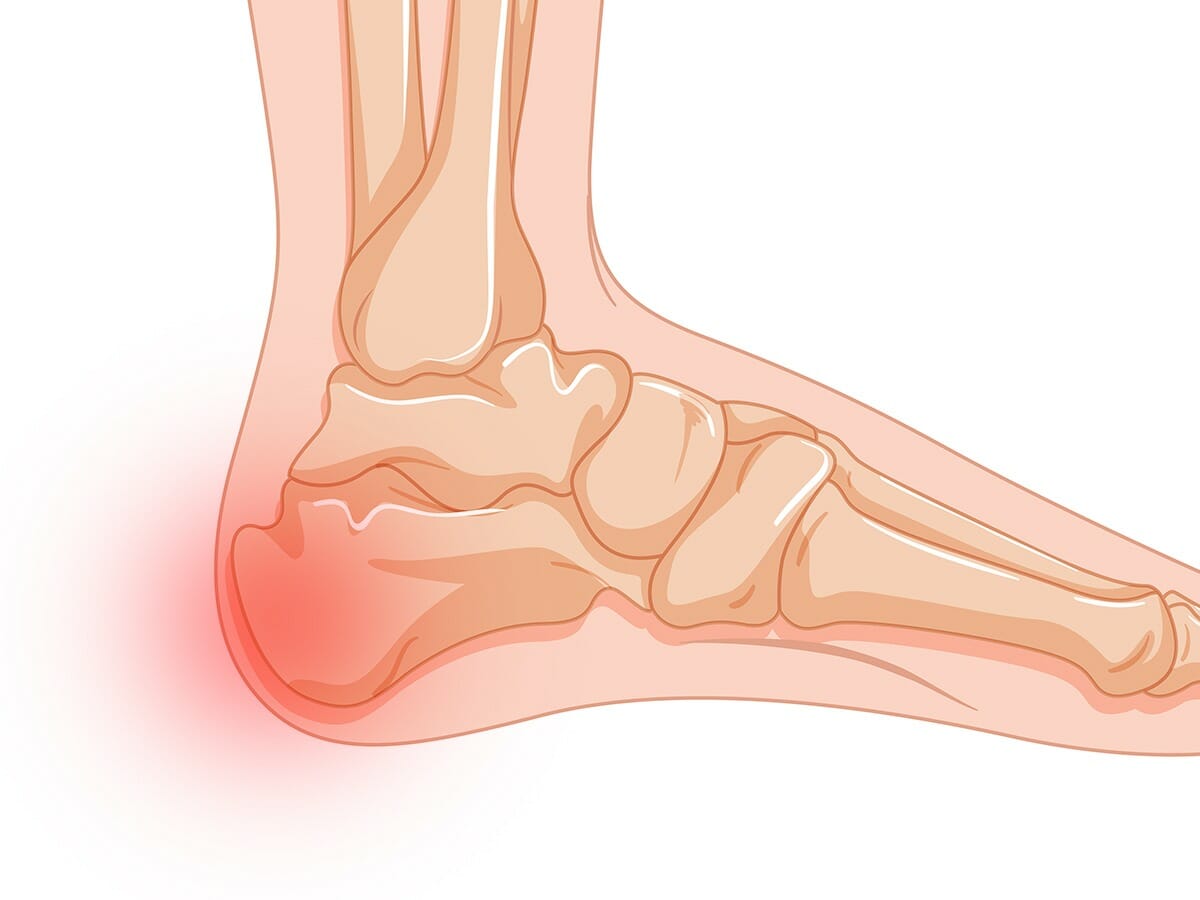Calcaneal Apophysitis-Sever's Disease Heel Pain Treatment At Home Options