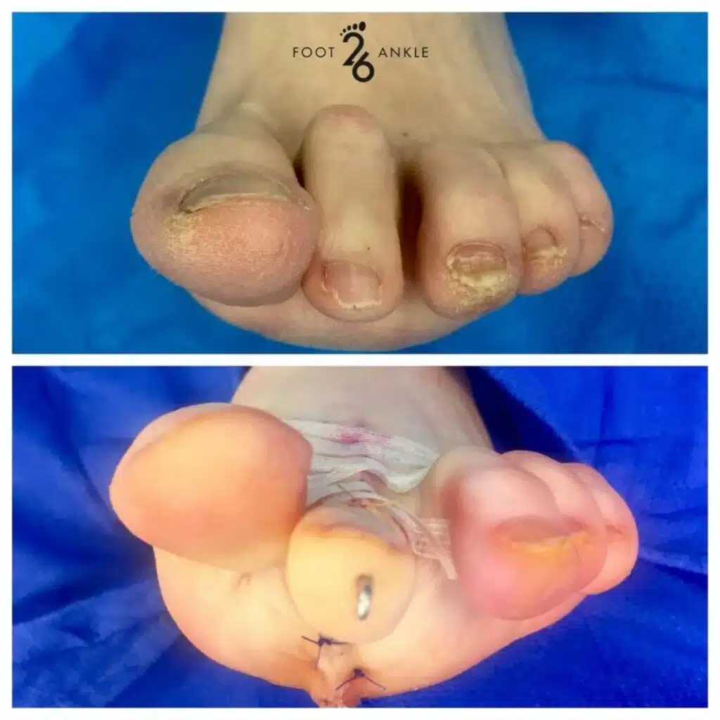 Plantar Plate Repair 8 Plantar plate repair procedure for treating forefoot pain and toe instability.