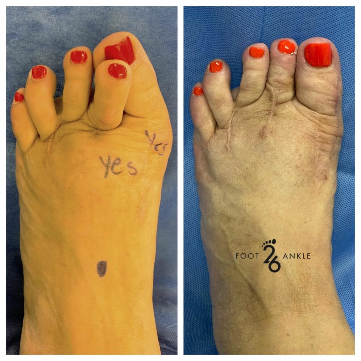 Hammertoe Surgery Cross Over Toe 26 Foot & Ankle