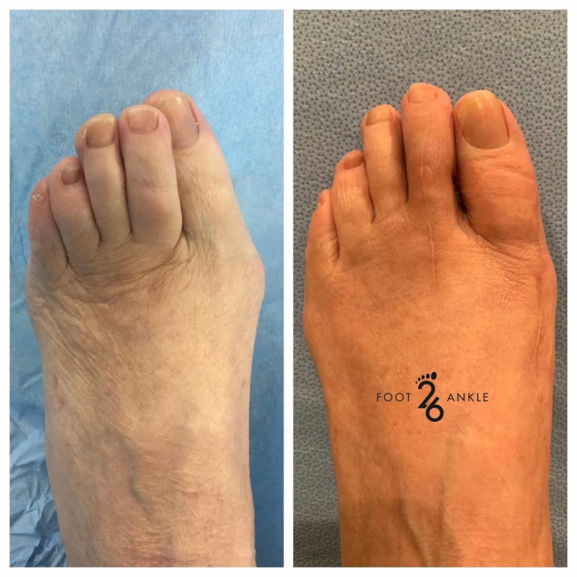 Hammertoe Surgery Cross Over Toe 26 Foot & Ankle