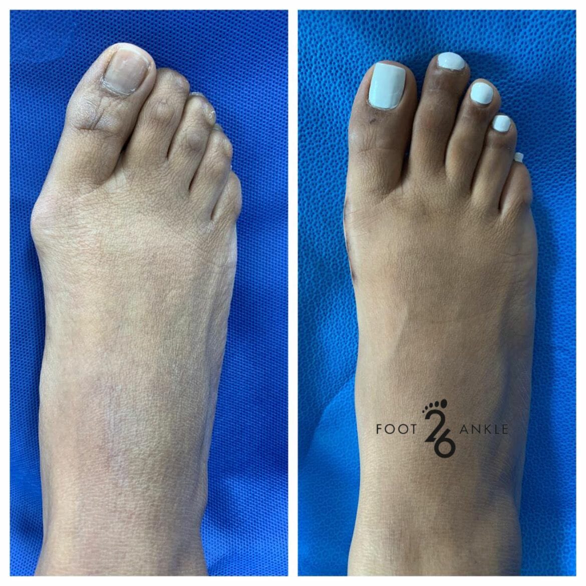 Hammertoe Surgery 26 Foot & Ankle