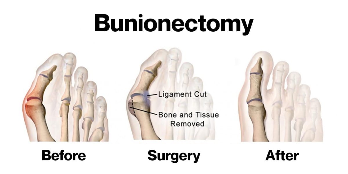 Understanding Traditional Bunion Surgery: A Step-By-Step Guide