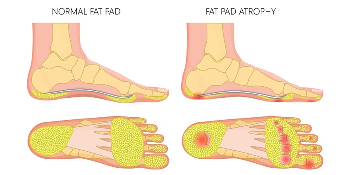 What is Fat Pad Atrophy and How Do You Treat It?