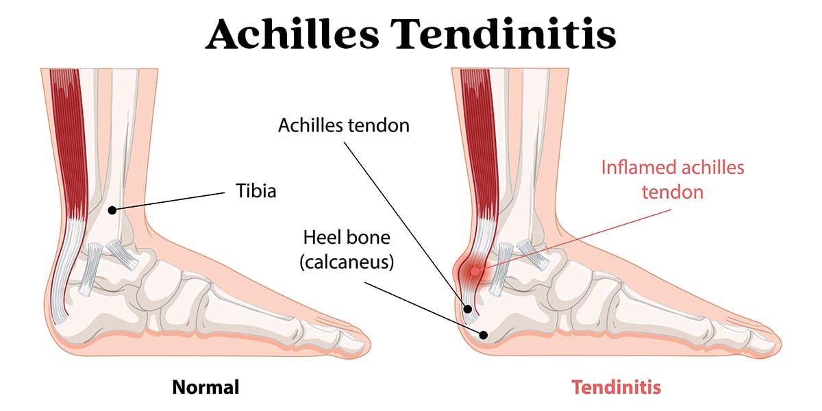 Achilles Tendonitis Surgical Treatment: Tendon Debridement with Graft Jacket and Casting