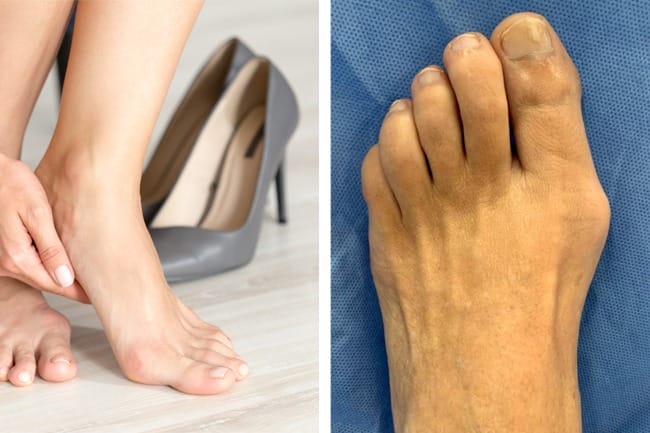 plantar plate injuries cause