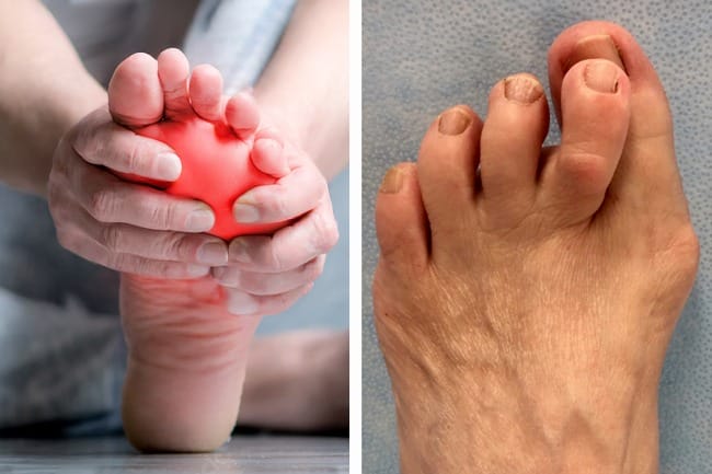 plantar plate injuries symptoms