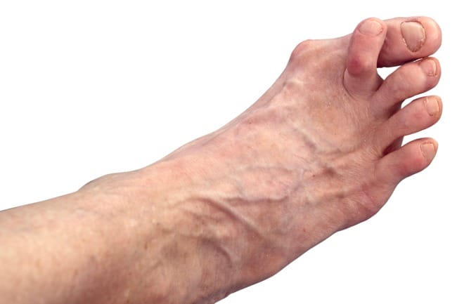 crossover toe - hammertoe