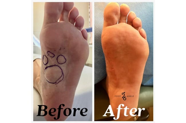 plantar fibroma before and after
