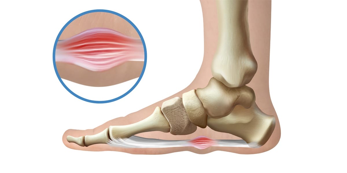plantar fibromas
