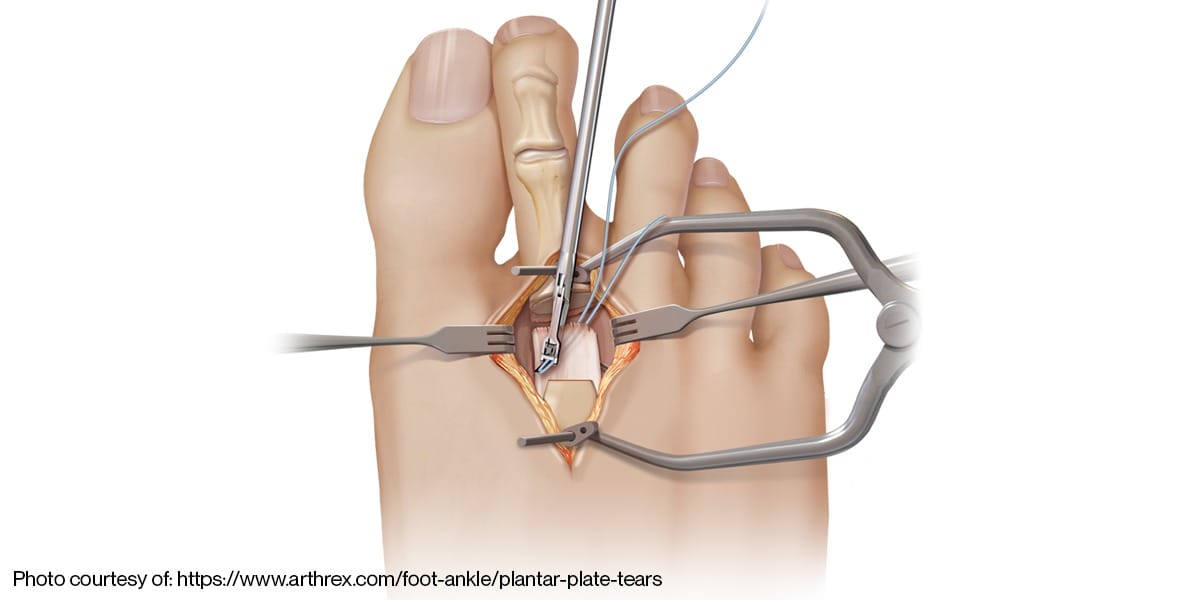 Rebuilding Stability: The Importance of Plantar Plate Repair