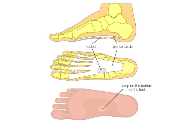 what is plantar fibroma