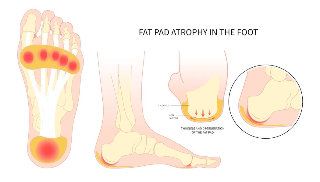 Fat Pad Atrophy Treatment: Top Solutions for Foot Pain