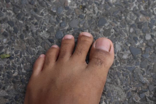 toe splay