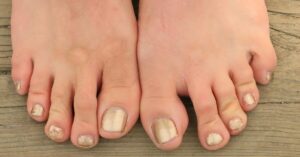 Toe Lengthening