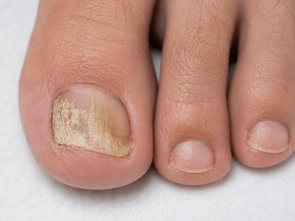 toenail fungus