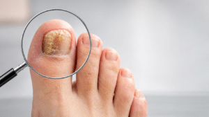 toenail problems