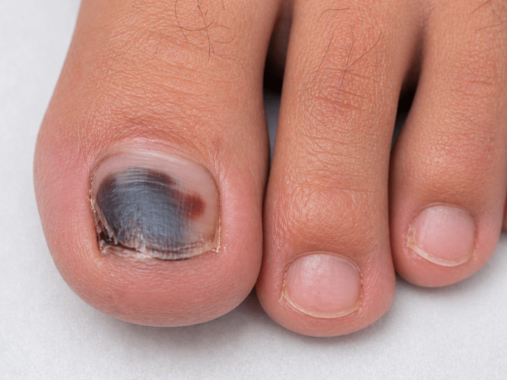 toenail trauma